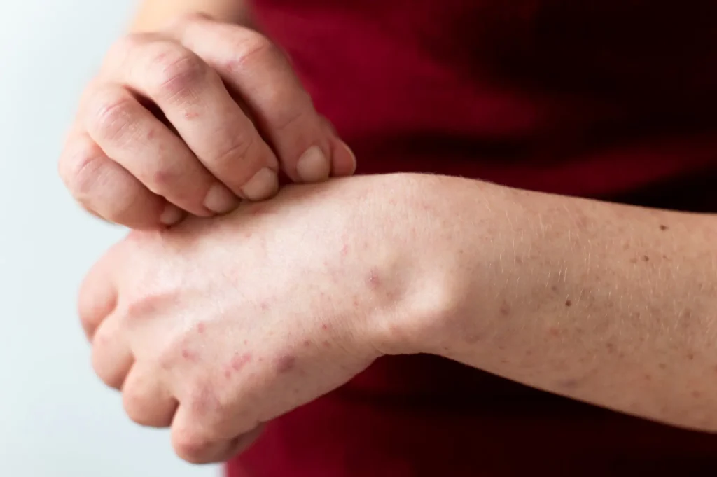 Contact Dermatitis 1024x681